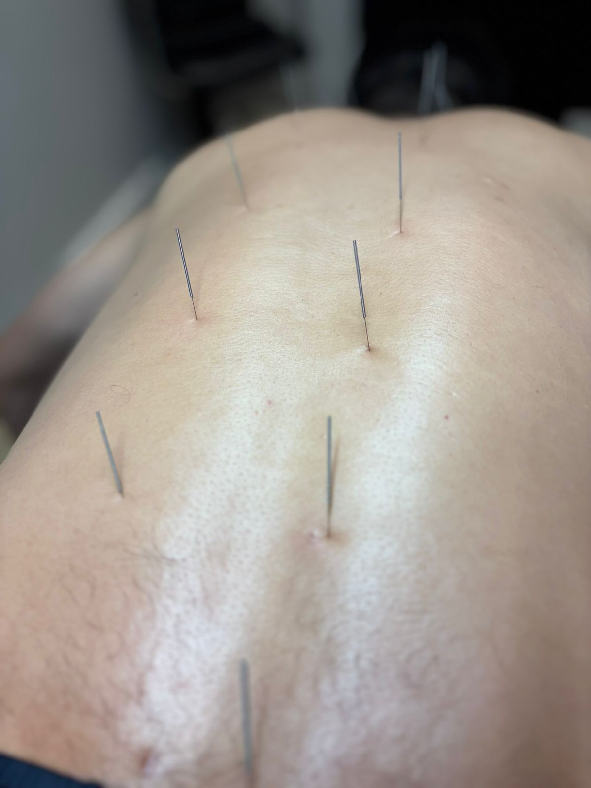 Dry Needling e Acupuntura